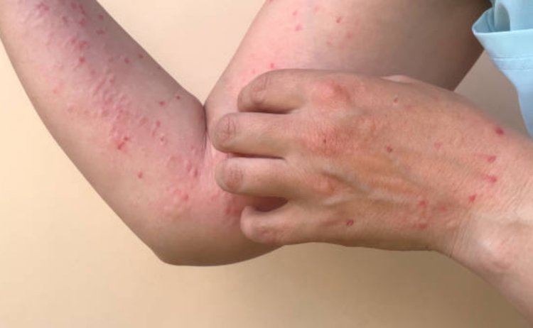 Mueren dos rarámuris por sarampión en Chihuahua; suman 16 fallecimientos en ese estado